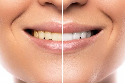 Wybielanie zębów przed ślubem – bezpieczne i skuteczne metody